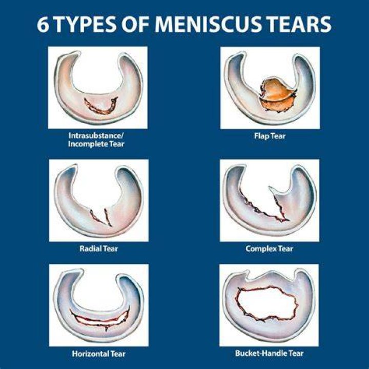 Can You Climb Stairs After Meniscus Surgery