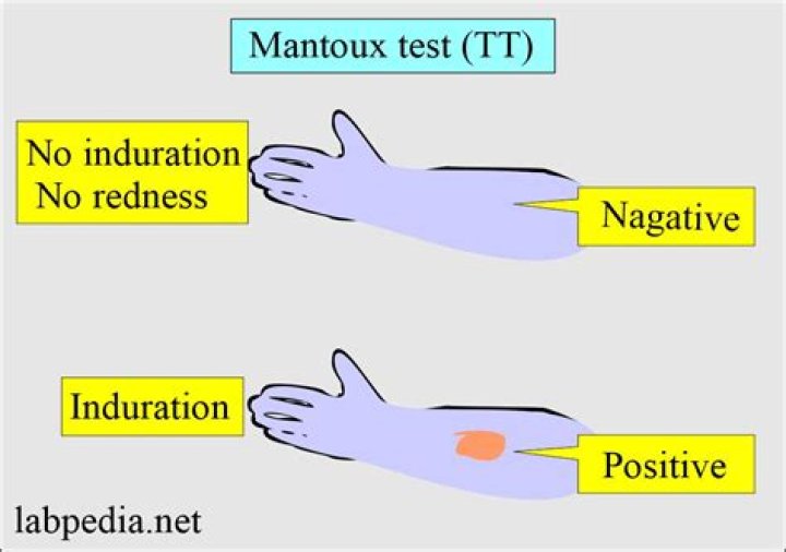 How do you read a Mantoux test