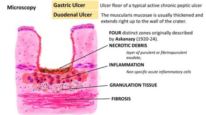 Is gastric erosion the same as an ulcer