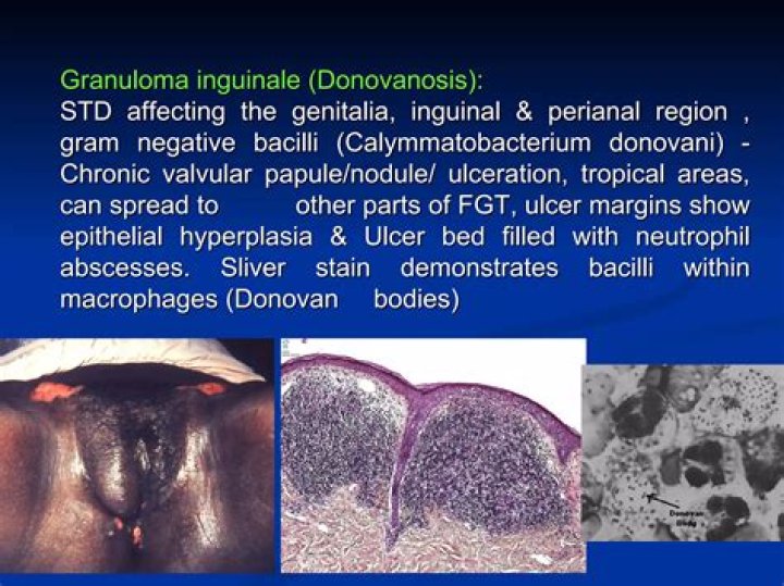 Is granuloma Inguinale an STD