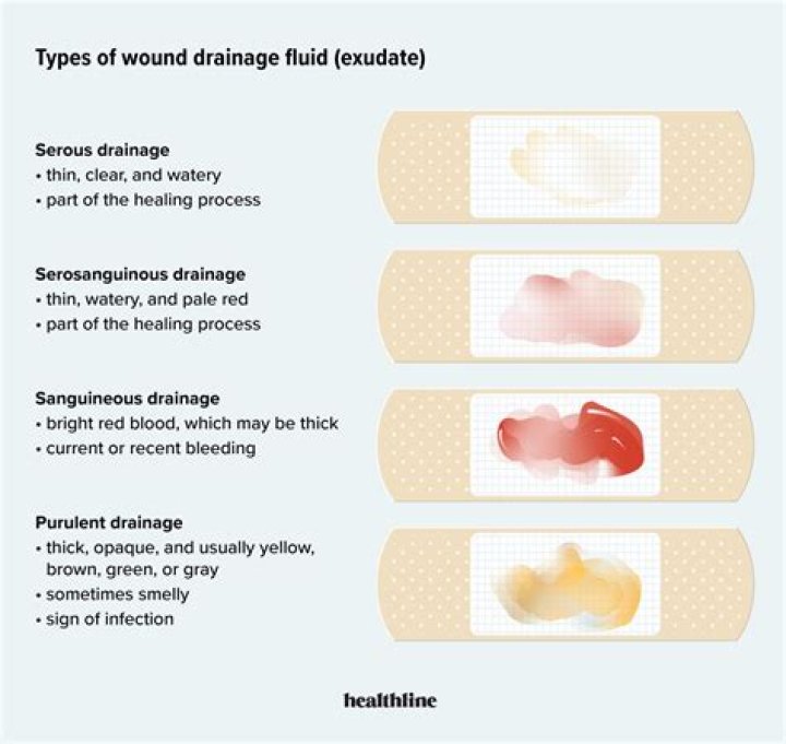 Is Serosanguinous drainage a sign of infection