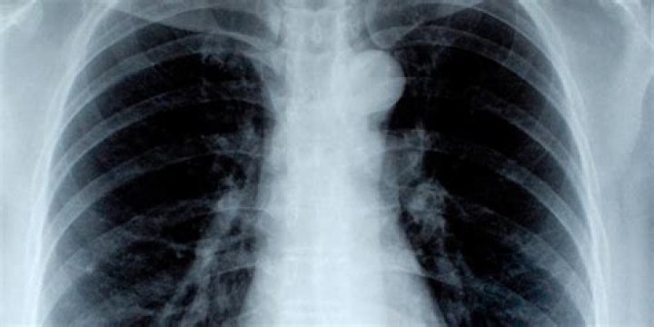 ¿Qué es una herida penetrante en el torax