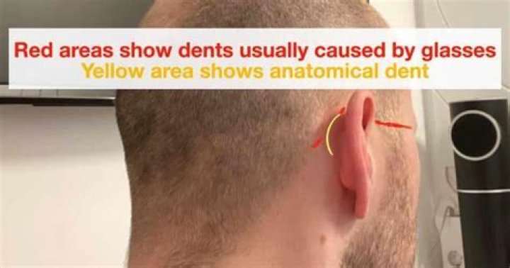 Quick Answer: Can Wearing Sunglasses On Head Cause Dent In Skull