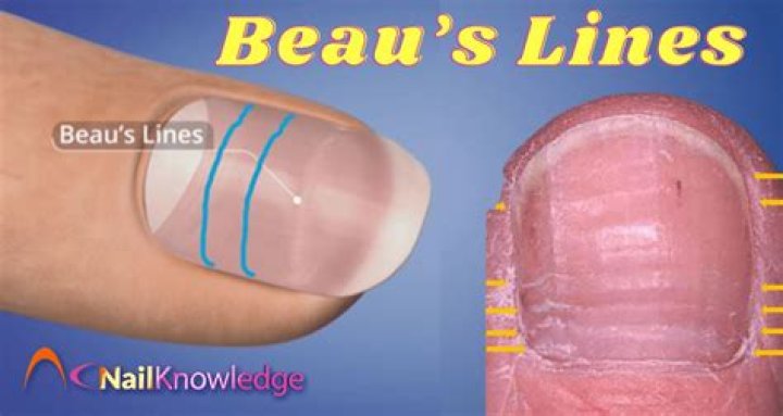 What do Mees lines indicate