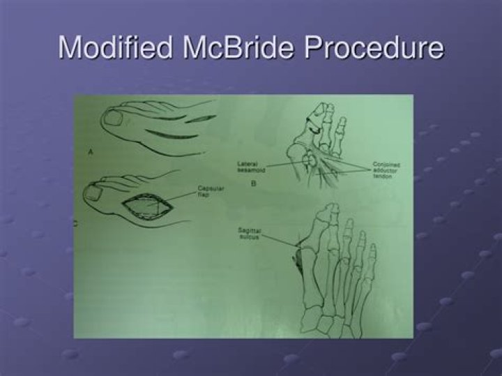 What is a modified McBride procedure