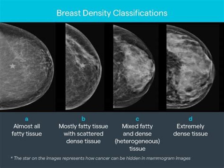 What is ACR breast density