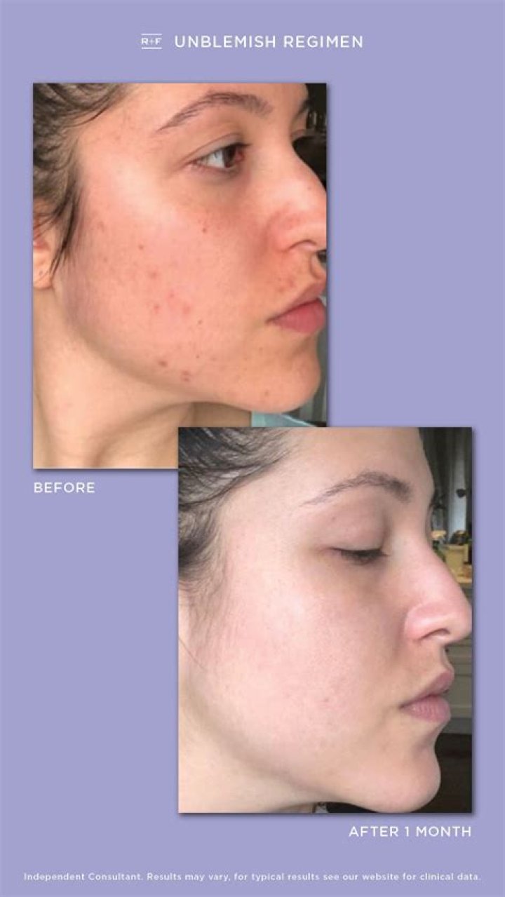 What is in Rodan and Fields acne
