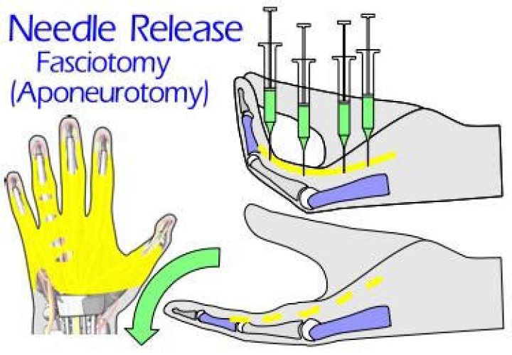 What is Needle Aponeurotomy