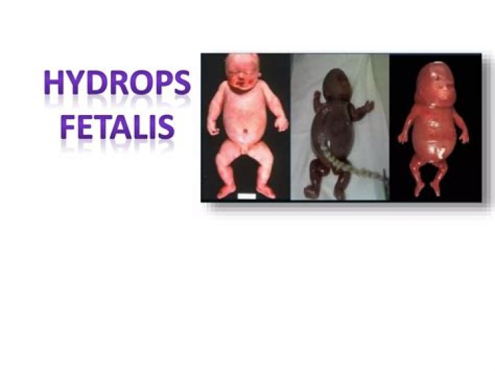 What is the cause of hydrops Fetalis