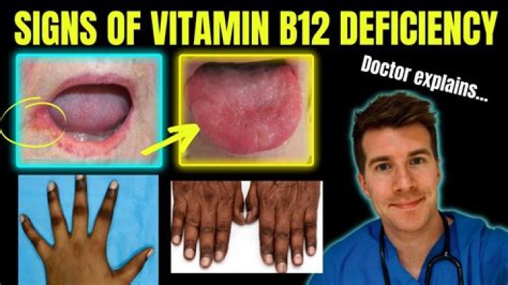 What known vitamin deficiency can cause burning mouth syndrome