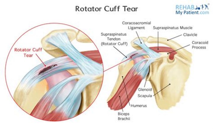 Which is more useful the full can test or the empty can test in detecting the torn supraspinatus tendon