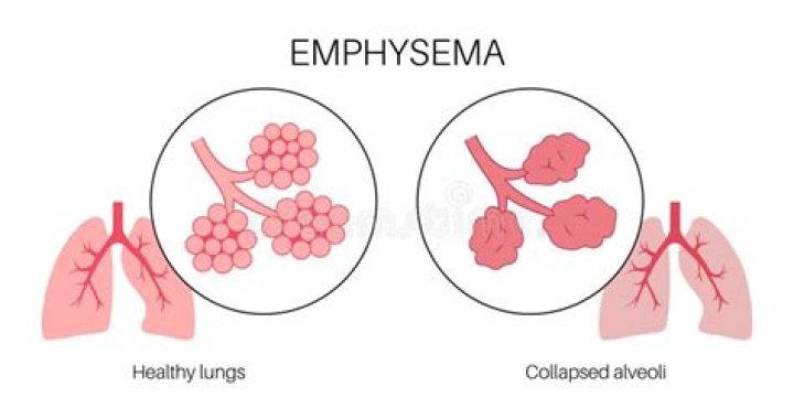 Why do the walls of the air sacs disintegrate in emphysema